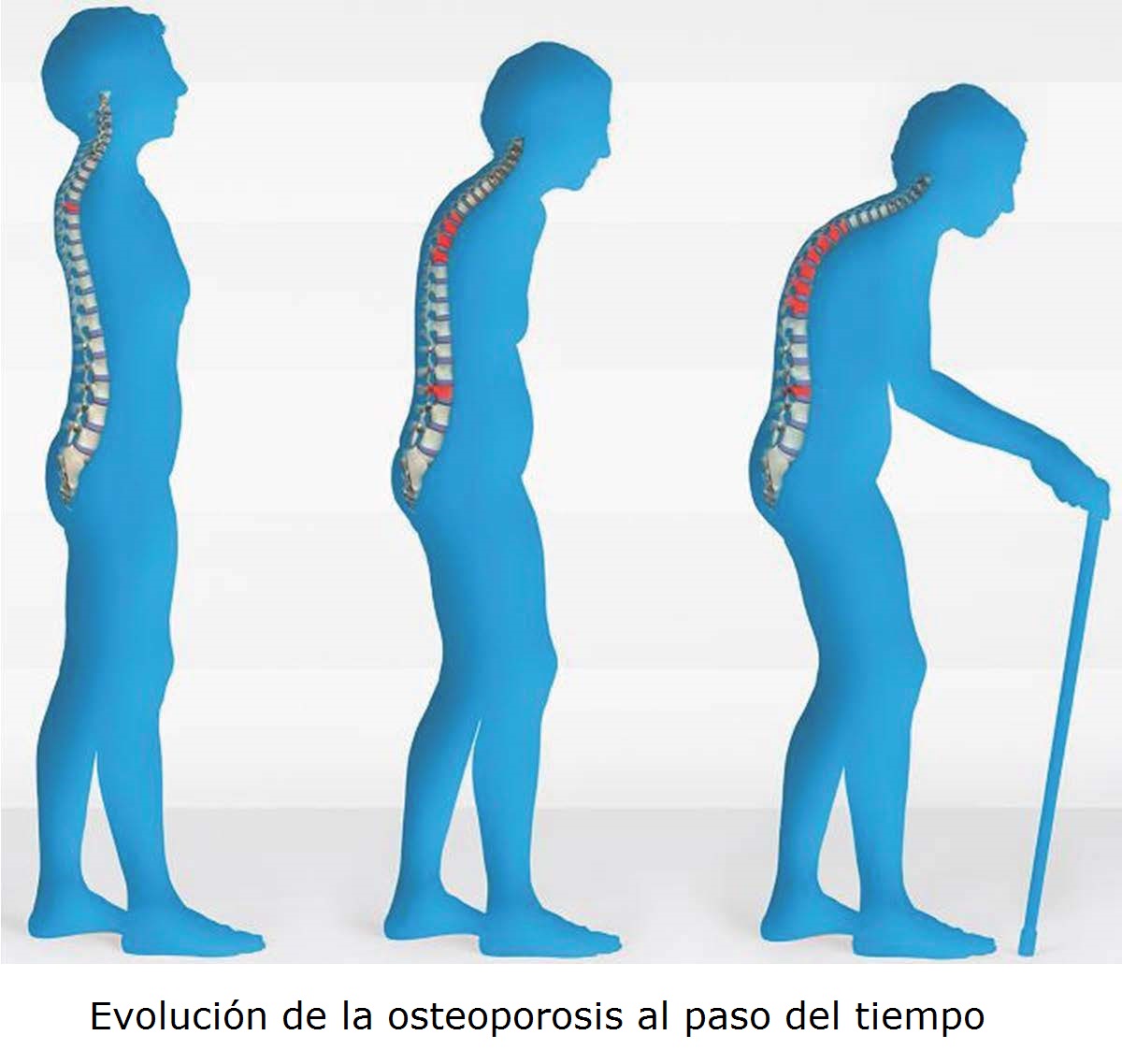 Evolución-osteoporosis